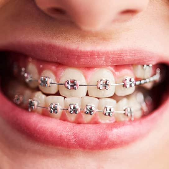 braces orthodontist