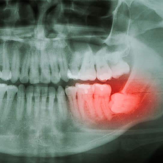 Wisdom Teeth