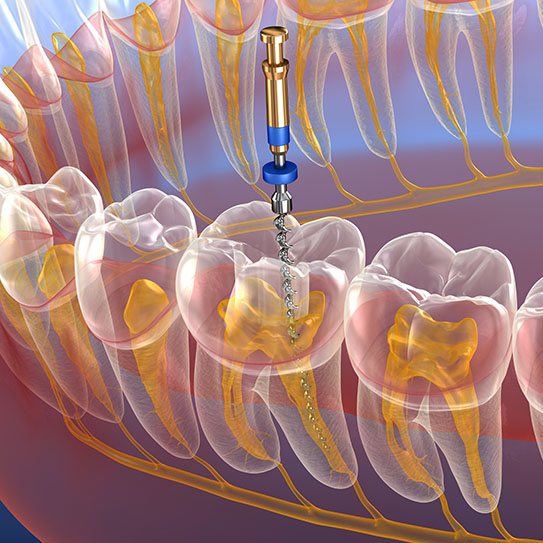 endodontist, endodontic treatment