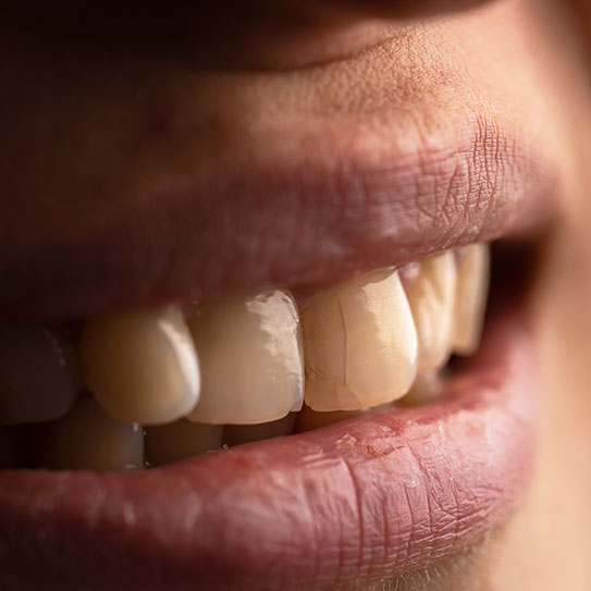 cracked teeth
